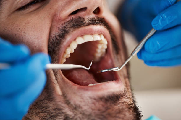 Best Emergency Dental Extractions in San Antonio, FL
